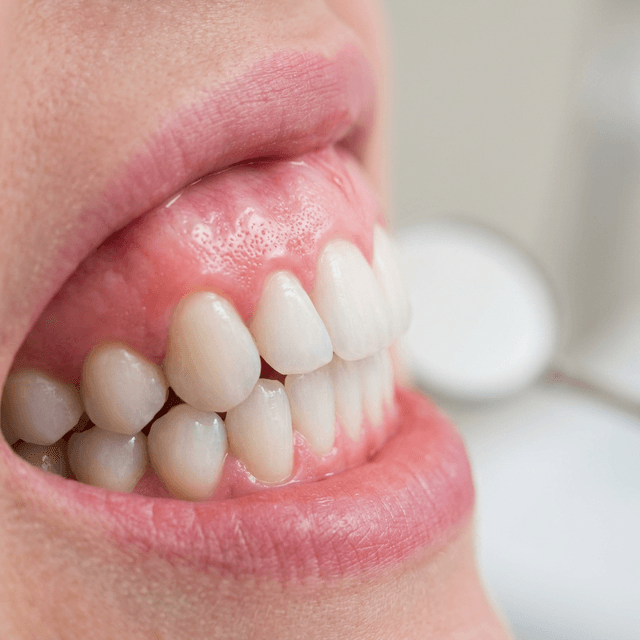 Periodontoloji - Diş Eti Hastalıkları